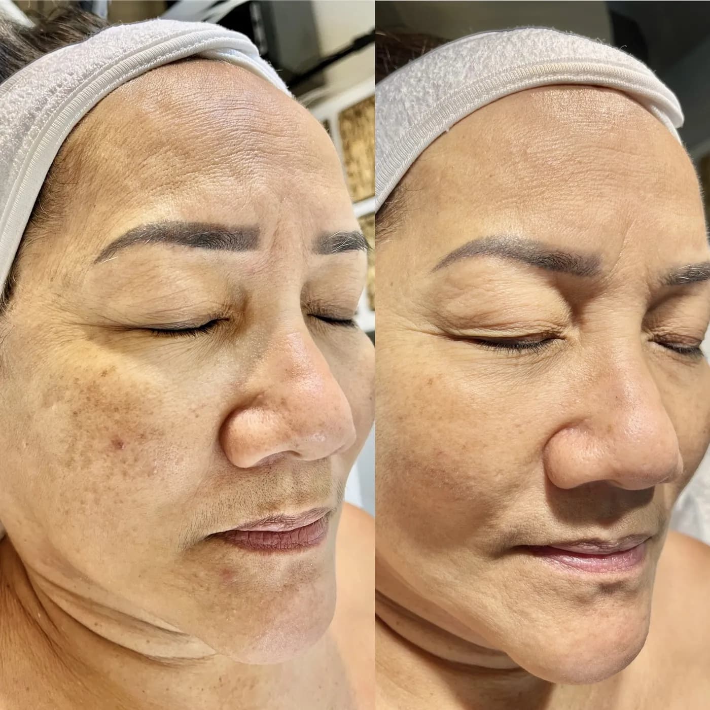 Before and after of a holistic facial by Nikolle, transformation VI